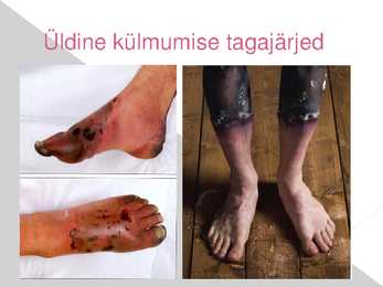 Kehaosade külmumine ja kuumenemine-tagajärjed #12