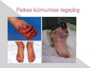 Kehaosade külmumine ja kuumenemine-tagajärjed #9