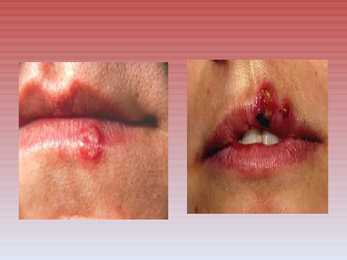 Herpes simplex ehk herpesviirus #9