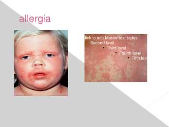 Erinevate allergiate tekkimine ja vältimine puidugatöötamisel #8