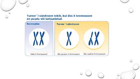 Turneri sündroom #5
