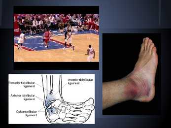 Sports injuries #4