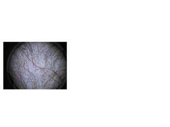 Trihhotillomaania #2