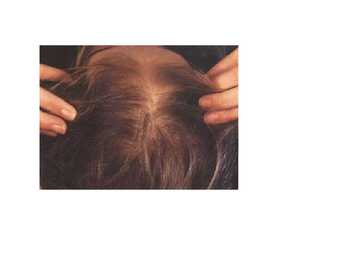 Trihhotillomaania #9