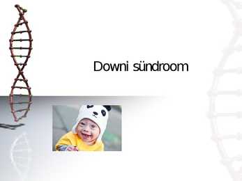 Downi sündroom
