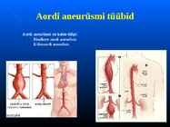 Aordi aneurüsm #4