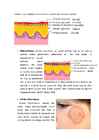 Eczema #3