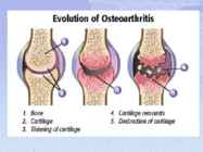 Osteoartroos #5