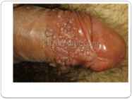 Herpes #11