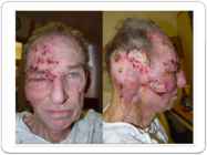 Herpes #13