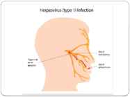 Herpes #3