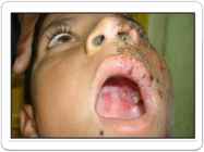 Herpes #6