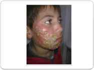 Herpes #10