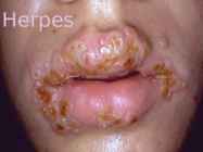 Herpes