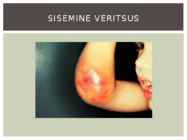 Hemofiilia #7