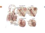 Tsüstiline fibroos #11
