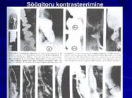 Gastroenteroloogia e-seedeelundite haigused #38