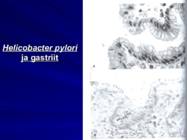 Gastroenteroloogia e-seedeelundite haigused #43