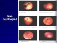 Gastroenteroloogia e-seedeelundite haigused #49