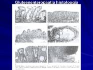 Gastroenteroloogia e-seedeelundite haigused #51