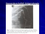 Gastroenteroloogia e-seedeelundite haigused #61