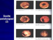 Gastroenteroloogia e-seedeelundite haigused #65