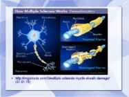 Sclerosis Multiplex #14
