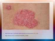 Psoriaas #11
