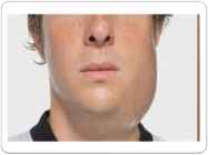 Mumps #3