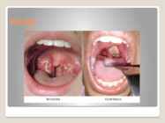 Difteeria #7