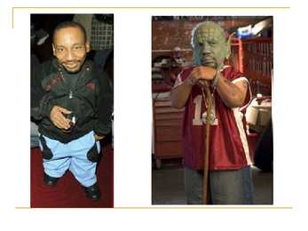 Dwarfism #16