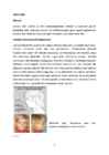 Adenoid