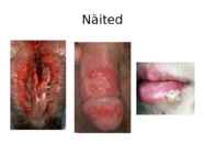 Genitaalherpes #9