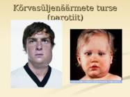 Mumps #7