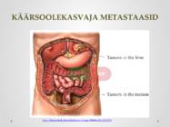Kasvajate levimisteed-Retsidiveerumine #11