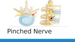 Pinched nerve