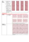 EKG konspekt #14