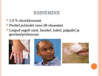 Vitiliigo #4
