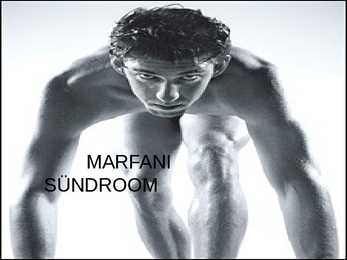Marfani sündroom