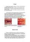 Herpes #2