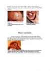 Herpes #3