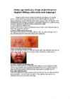 Herpes #4