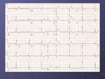 EKG #5