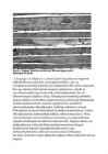 Elupuhune lihasatroofia #2