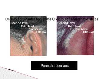 Psoriaas #11