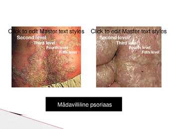Psoriaas #9