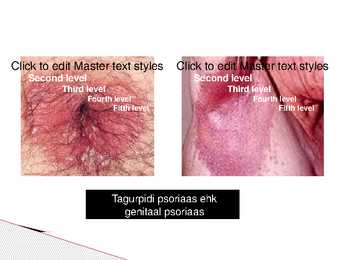 Psoriaas #10