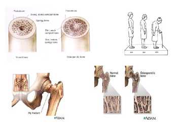 Haigus-Osteoporoos #8