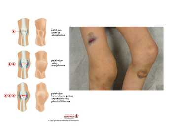 Hemofiilia presentatsioon #7