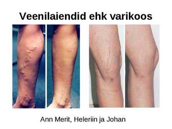 Veenilaiendid